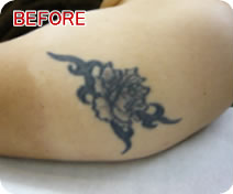 刺青・タトゥー除去　症例写真