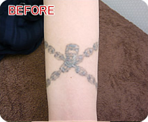 刺青・タトゥー除去　症例写真