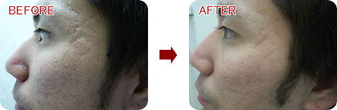 男性の両頬とこめかみのニキビ・ニキビ跡治療