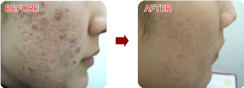 女性の両頬のニキビ・ニキビ跡治療